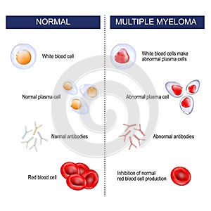 Multiple myeloma