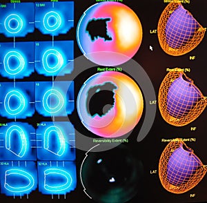 Myocardial defect nuclear medicine photo