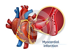 Myocardial infarction. 3d Realostic Heart