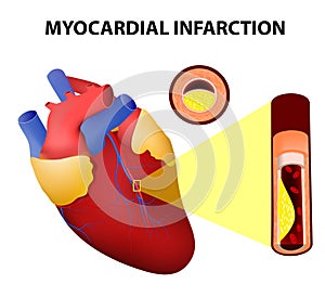 Myocardial infarction