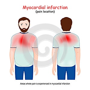 Myocardial Infarction areas. Heart attack. pain location