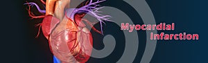 Myocardial infarction photo