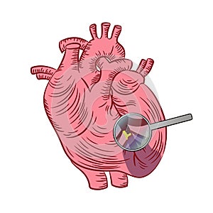 MYOCARDIAL INFARCTION Heart Disease Medicine Education Scheme photo