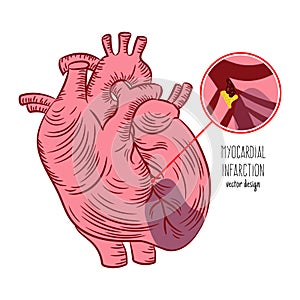 MYOCARDIAL INFARCTION SCHEME Heart Attack Medicine Education