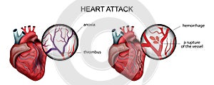 Myocardial infarction. thrombosis and hemorrhage photo