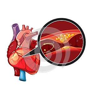 Myocardial infarction vector photo
