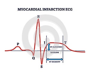 Myocardial infraction ECG with abnormal ST segment elevation outline diagram