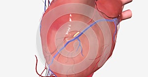 Myocardial ischemia is caused by reduced blood flow to the heart