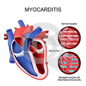 Myocarditis. inflammatory cardiomyopathy. Cross section of a human heart and Myocardium photo