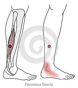 Myofascial trigger points in the Peroneus brevis muscle can cause pain in the outer ankle