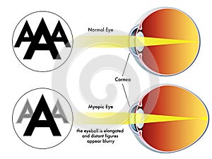 Myopia