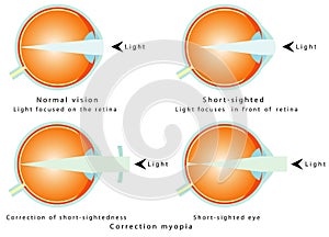 Myopia