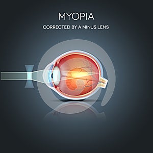 Myopia corrected