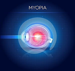 Myopia eyesight disorder