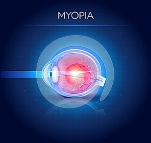Myopia eyesight disorder photo
