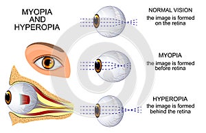 Myopia and hyperopia