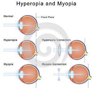 Myopia and Hyperopia photo