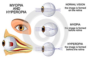 Myopia and hyperopia photo