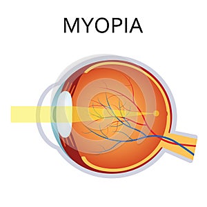 Myopia. Myopia is being short sighted. photo