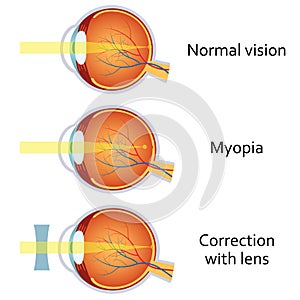 Myopia and myopia corrected by a minus lens.