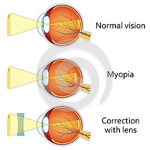 Myopia and myopia corrected by a minus lens.