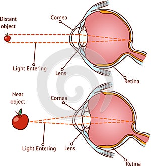 Myopia and normal vision photo