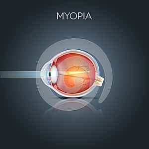 Myopia, short sighted eye photo