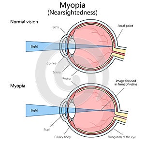 Myopia structure diagram medical science