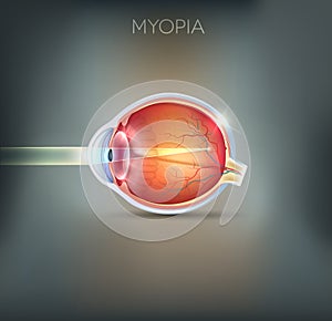 Myopia, vision disorder