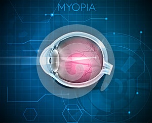 Myopia, vision disorder