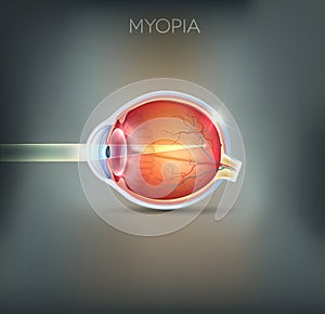Myopia, vision disorder photo