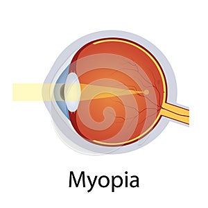 Myopia and Vision Disorders Illustration. Eyes Defect Concept. Detailed Anatomy Eyeball with Myopia Defect. Isolated