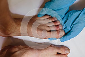 Mysterious skin condition that causes purple, blue or red discoloration in toes and occasionally fingers. New symptom of