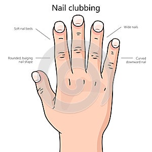 Nail clubbing medical science