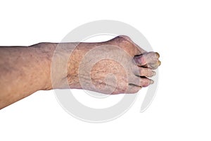 Nail disease, old dirty foot, homeless person. Finger defects Isolate on a white background.