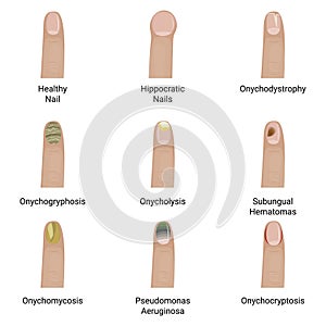 Nail diseases vector illustration design.