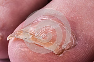 Nail fungus on legs. Close-up on a white background