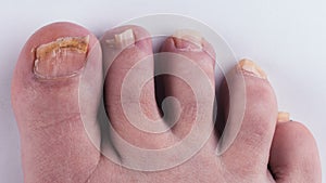 Nail fungus on legs. Close-up on a white background