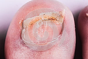 Nail fungus on legs. Close-up on a white background