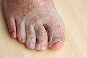 Nail fungus on the toenails and skin spots photo