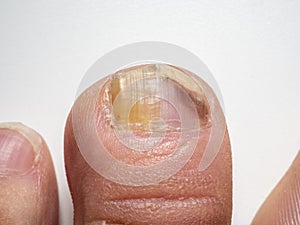 Nail infections caused by fungi such as: onychomycosis also known as tinea unguium. Caused by dermatophytes and yeasts