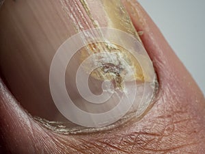 Nail infections caused by fungi such as: onychomycosis also known as tinea unguium. Thumb infection