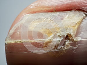 Nail infections caused by fungi such as: onychomycosis also known as tinea unguium. Thumb infection
