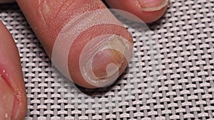 Nail infections caused by fungi such as: onychomycosis caused by dermatophytes and yeasts and for the concomitant antibacterial