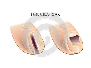 Nail melanoma