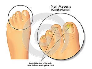 Nail mycosis