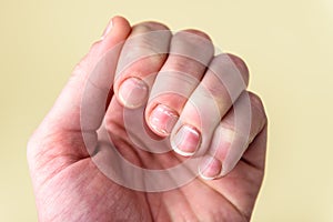 Nails with white spots on yellow background. Leukonychia, calcium deficit.