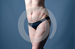 Naked belly and thighs of a woman after childbirth. Female stretch marks on the skin of the abdomen and legs
