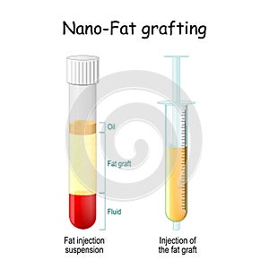 Nano-Fat grafting. test tube with Fat injection suspension. syringe with Injection of the fat graft