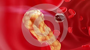Nanobot finds and removes forming cholesterol plaque